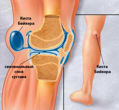 Физиотерапия при кисте бейкера коленного сустава 142