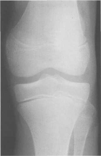 Гиалиновый хрящ коленного сустава норма толщина 124