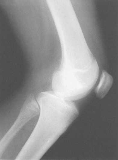 Гиалиновый хрящ коленного сустава норма толщина 143