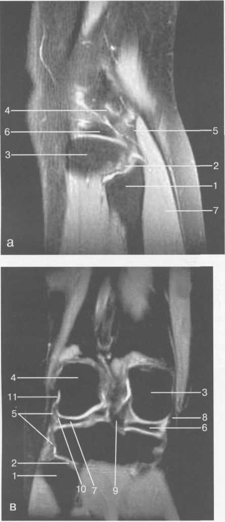 Гиалиновый хрящ коленного сустава норма толщина 13