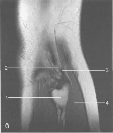 Гиалиновый хрящ коленного сустава норма толщина 21