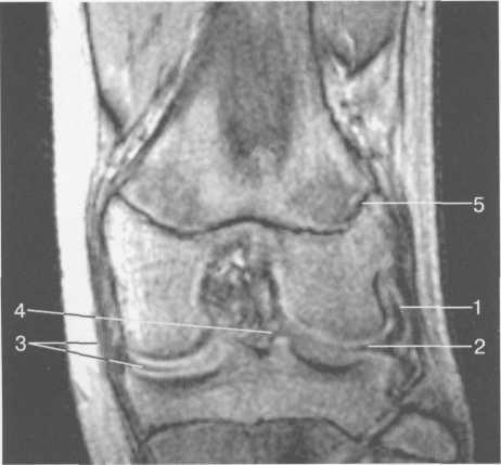 Гиалиновый хрящ коленного сустава норма толщина 151