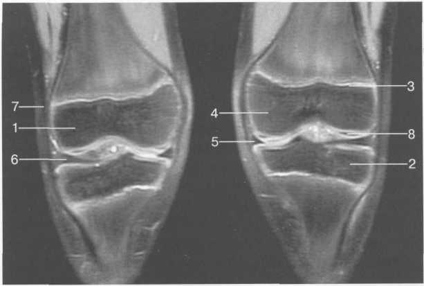 Гиалиновый хрящ коленного сустава норма толщина 11