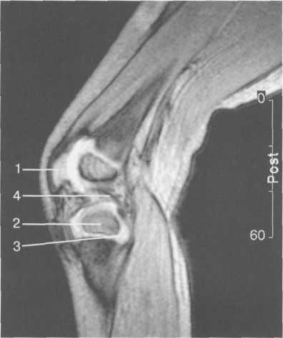 Гиалиновый хрящ коленного сустава норма толщина 175