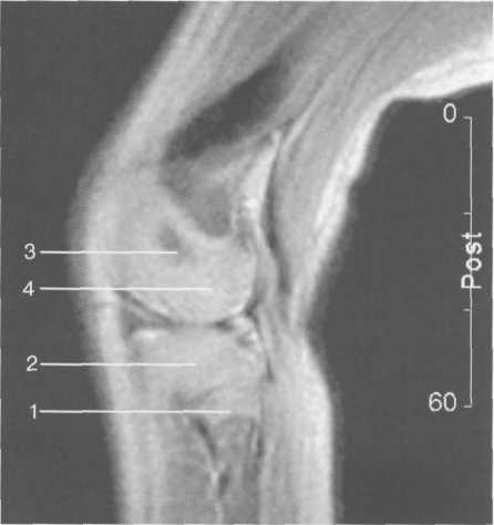 Гиалиновый хрящ коленного сустава норма толщина 74