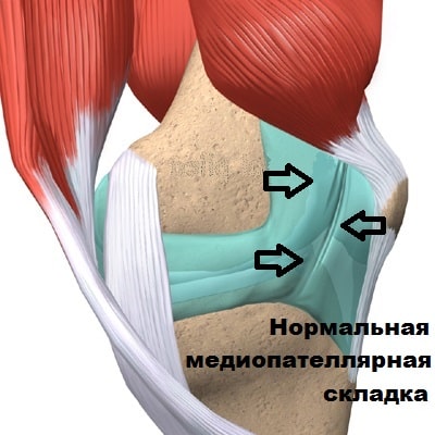 Гипертрофия коленного сустава 102