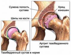 Хламидийный артрит коленного сустава симптомы и лечение 31