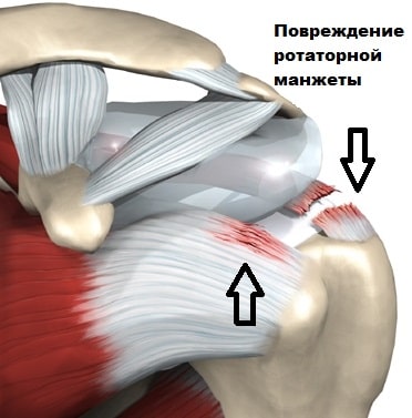 Импиджмент плечевого сустава 158