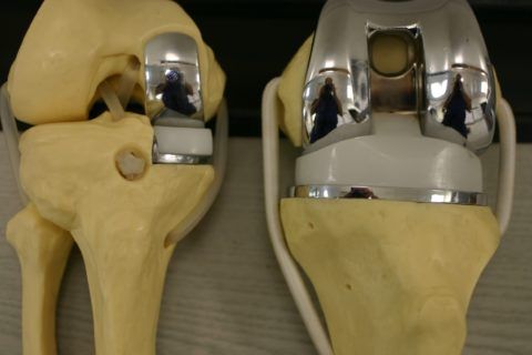Имплантанты для коленного сустава виды 106