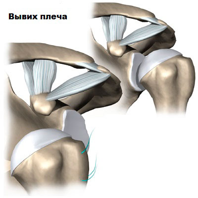 Как делают операцию на плечевом суставе? 185