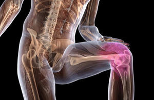 Как лечить остеоартроз коленного сустава? 181