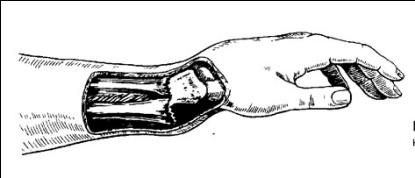 Как называется смещение кости в суставе? 130