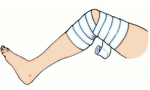Какая повязка применяется при повреждении коленного сустава? 131