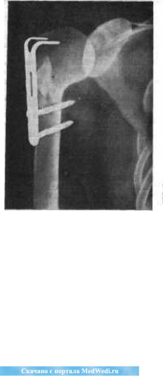 Какие суставы фиксируются при переломе плеча? 144