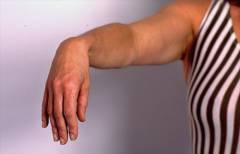 Какие суставы фиксируются при переломе плеча? 17
