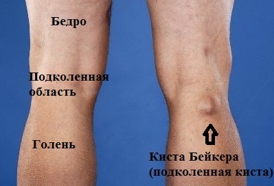 Киста коленного сустава к какому врачу обратиться 191
