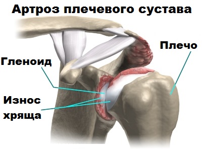 Клиника плечевого сустава 105