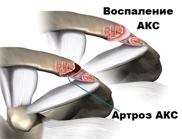Ключично акромиальный сустав анатомия 126