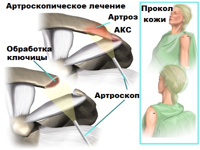 Ключично акромиальный сустав анатомия 94