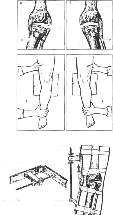 Код мкб повреждение связок коленного сустава 174