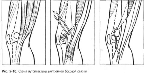 Код мкб повреждение связок коленного сустава 124