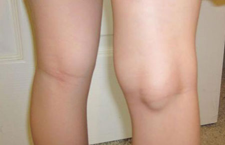 Консервативное лечение кисты бейкера коленного сустава 45