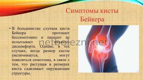 Консервативное лечение кисты бейкера коленного сустава 5