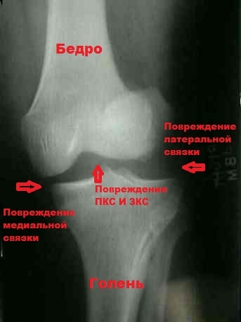 Латеральная связка коленного сустава 96