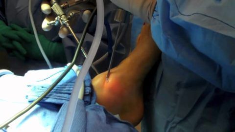 Лечебно диагностическая артроскопия коленного сустава 93