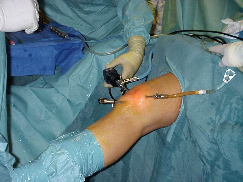 Лечебно диагностическая артроскопия коленного сустава 16
