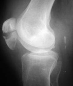 Лечебно диагностическая артроскопия коленного сустава 113