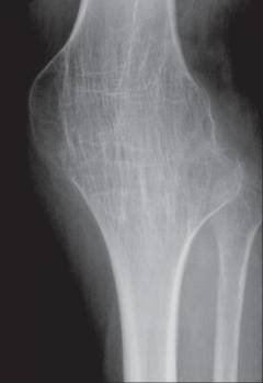 Лечебно диагностическая артроскопия коленного сустава 45