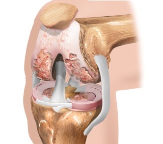 Лечение артроза правого коленного сустава 81