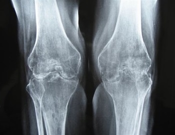 Лечение артроза правого коленного сустава 100