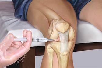 Лечение артроза правого коленного сустава 1