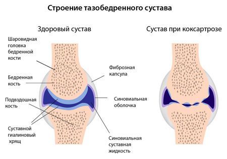 Лечение коксартроза коленного сустава 127