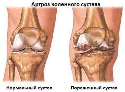 Лечение коленного сустава после травмы 37