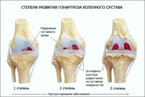 Лечение коленного сустава после травмы 100