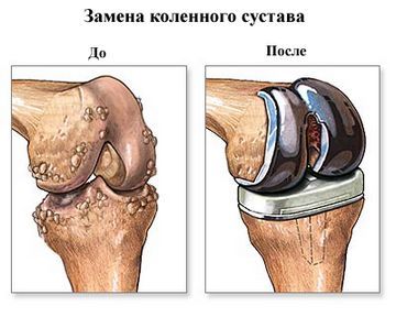 Лечение коленного сустава после травмы 132