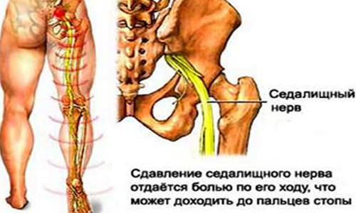 Лечение невралгии коленного сустава 128