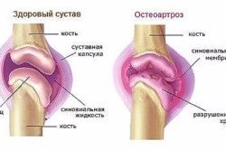 Лечение остеоартроза коленного сустава народными средствами 139