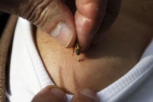 Лечение пчелами суставов 102