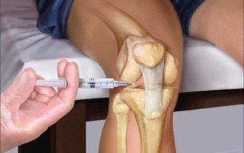 Лекарство для суставов коленей уколы 81