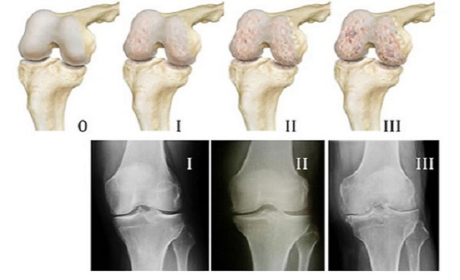 Левосторонний гонартроз коленного сустава 95