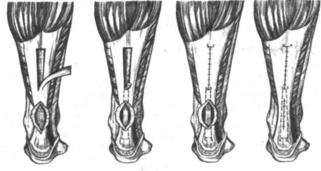 Мениск коленного сустава код по мкб 110