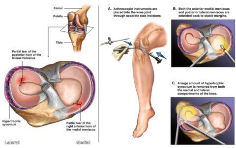 Мениски коленного сустава анатомия 133