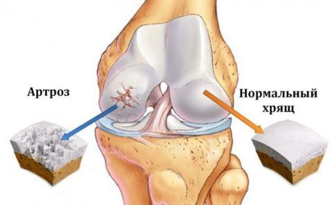Методы лечения артроза коленного сустава 3 степени 17