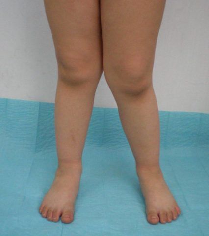 Методы лечения артроза коленного сустава 3 степени 100