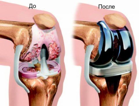 Методы лечения артроза коленного сустава 3 степени 29