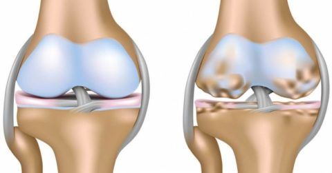 Можно ли вылечить начальный гонартроз коленного сустава? 8